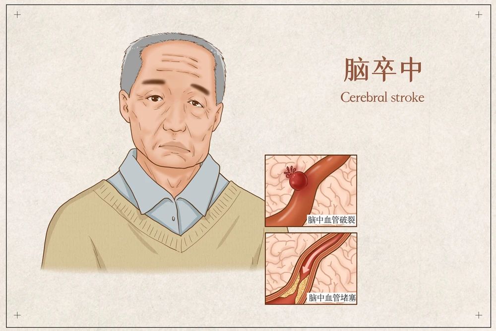 脑卒中.jpg