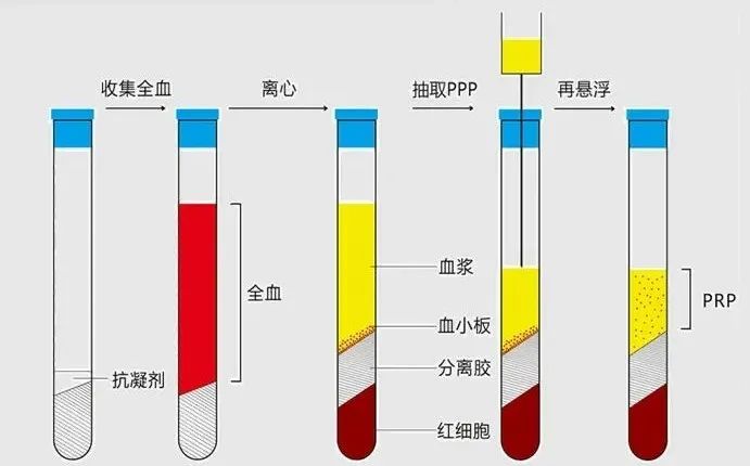 富血小板血浆.jpg